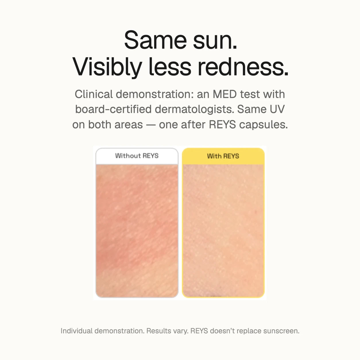 Same sun, visibly less redness. Clinical demonstration: an MED test with board-certified dermatologists, same UV on both areas, one after REYS capsules. Without REYS the skin is visibly red, with REYS it is not