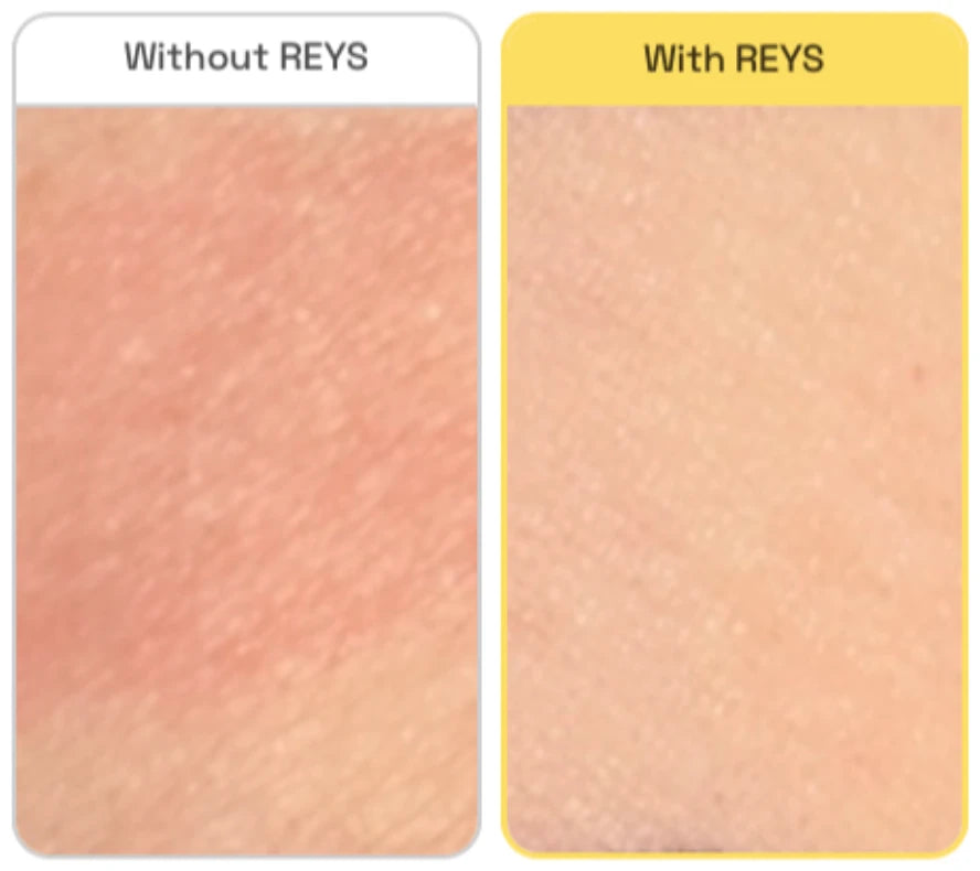 Two patches of skin after the same UV exposure: without REYS the skin is visibly red, with REYS it is not